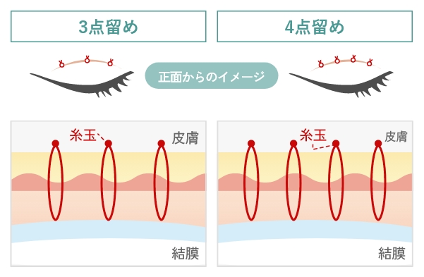 3点留めと4点留め