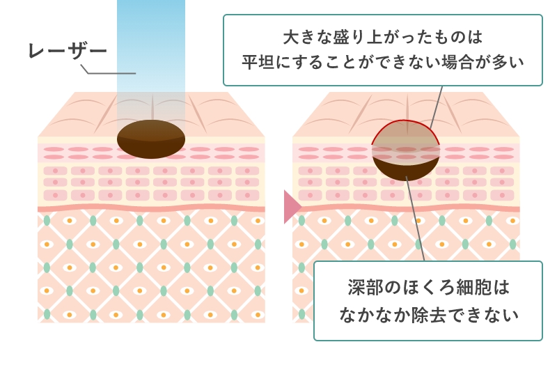 レーザー治療