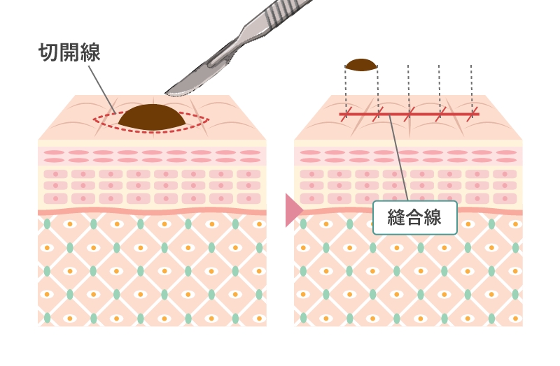 切開法