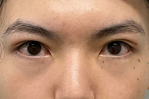 眼瞼下垂:術後