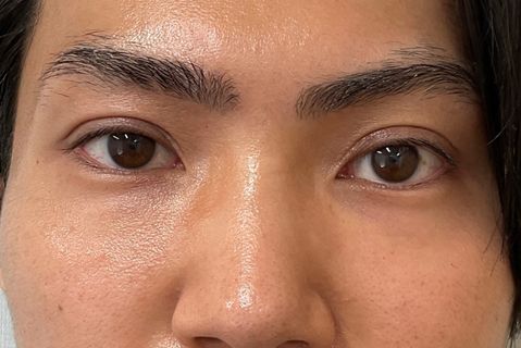 眼瞼下垂:術後