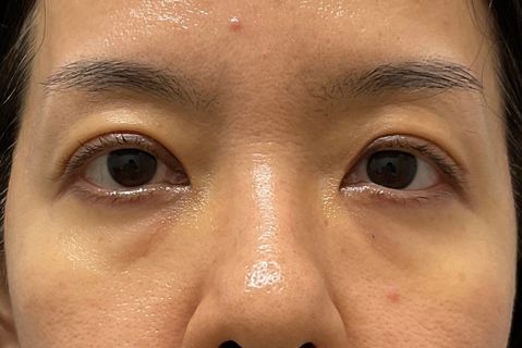 眼瞼下垂:術後