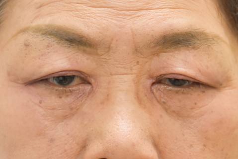 眼瞼下垂:術前