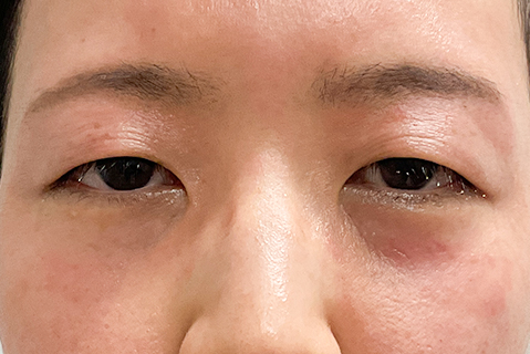 眼瞼下垂:術前