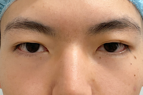 眼瞼下垂:術前