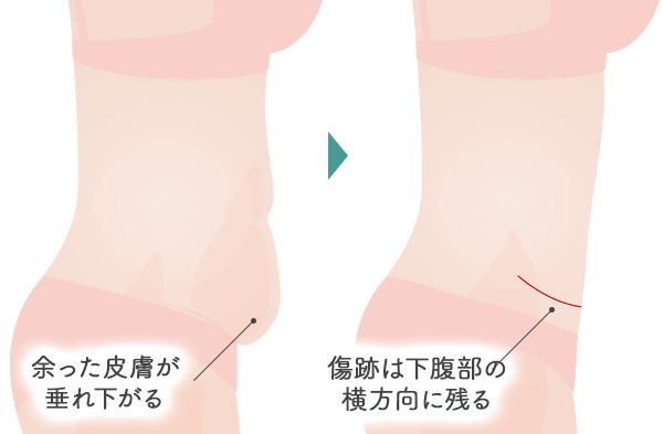 側面から見たタミータック術前・術後の変化