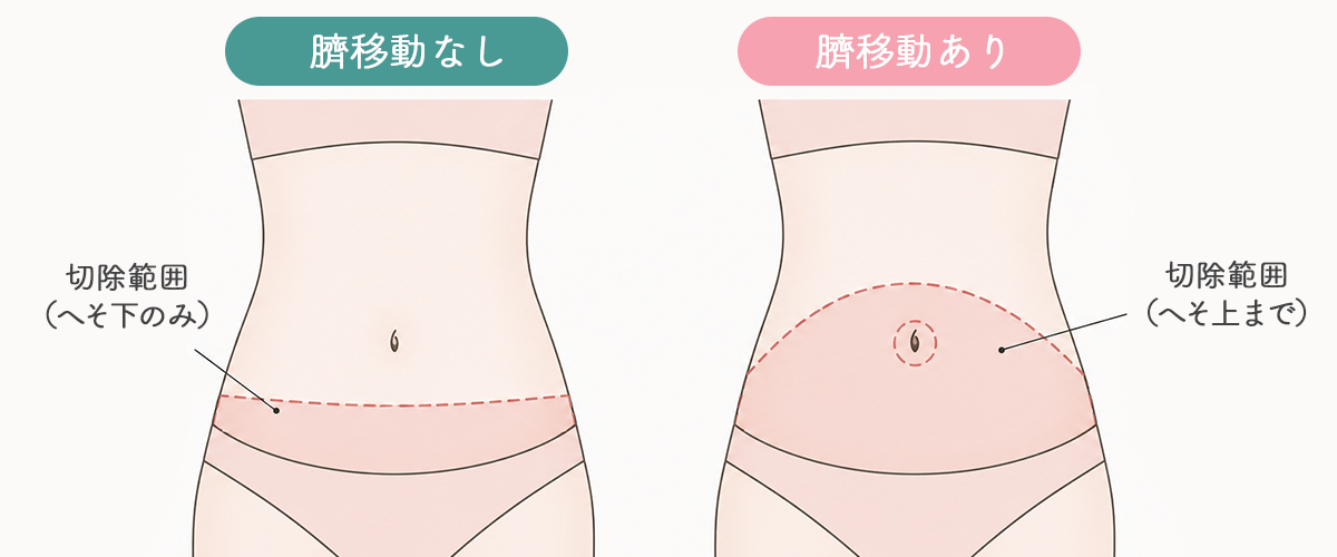 臍移動なし・臍移動ありの切除範囲比較