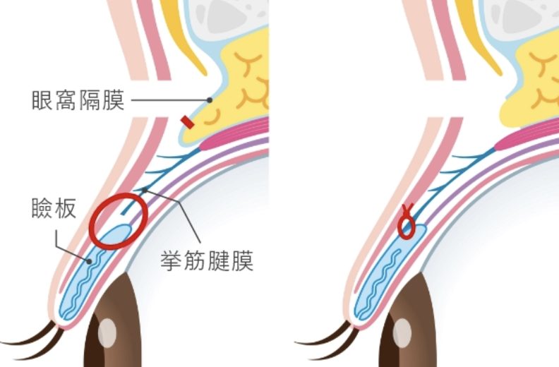 眼瞼挙筋前転法