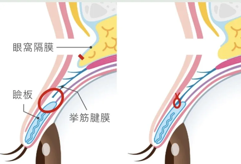 鋸筋前転式