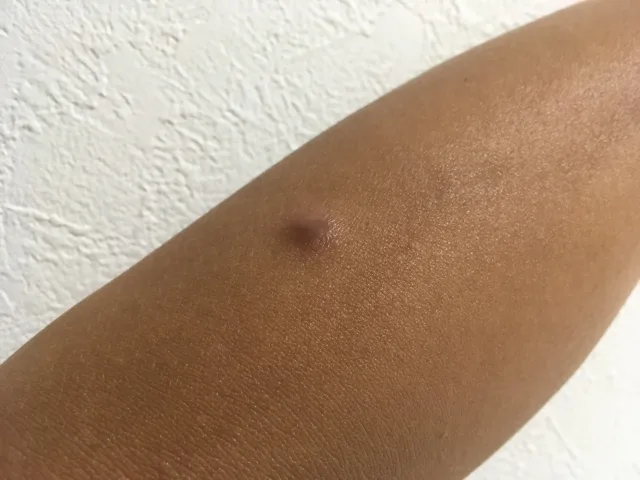 腕にできた皮膚のできもの