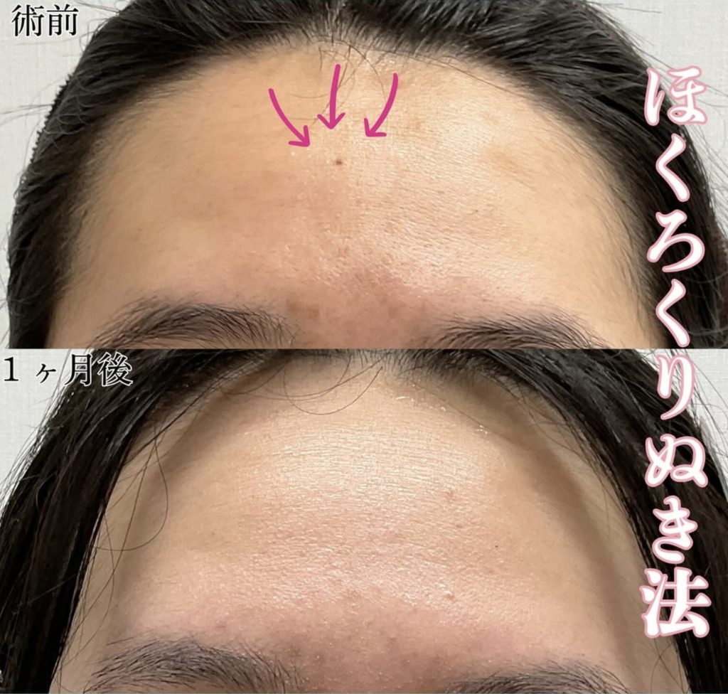 ほくろくり抜き法の症例写真