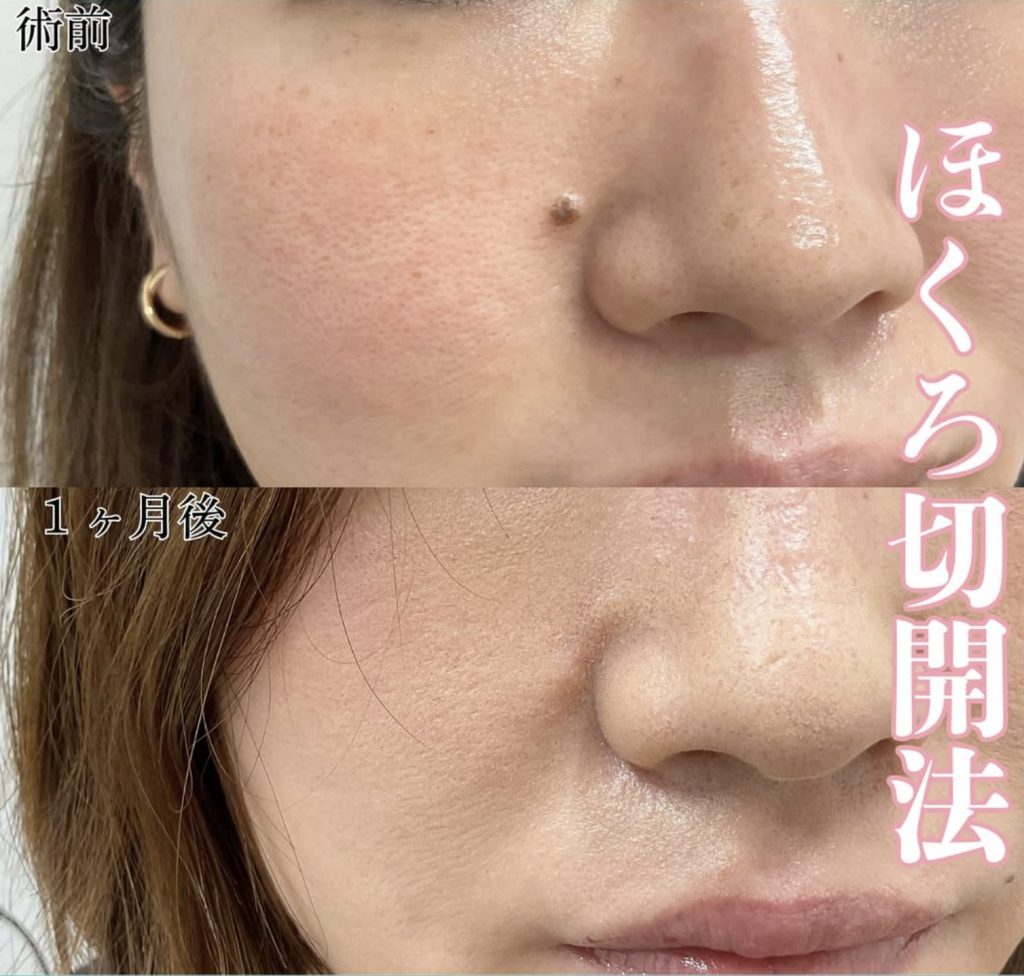黒子切開法症例