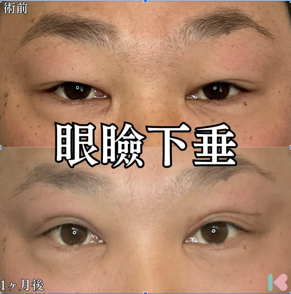 眼瞼下垂