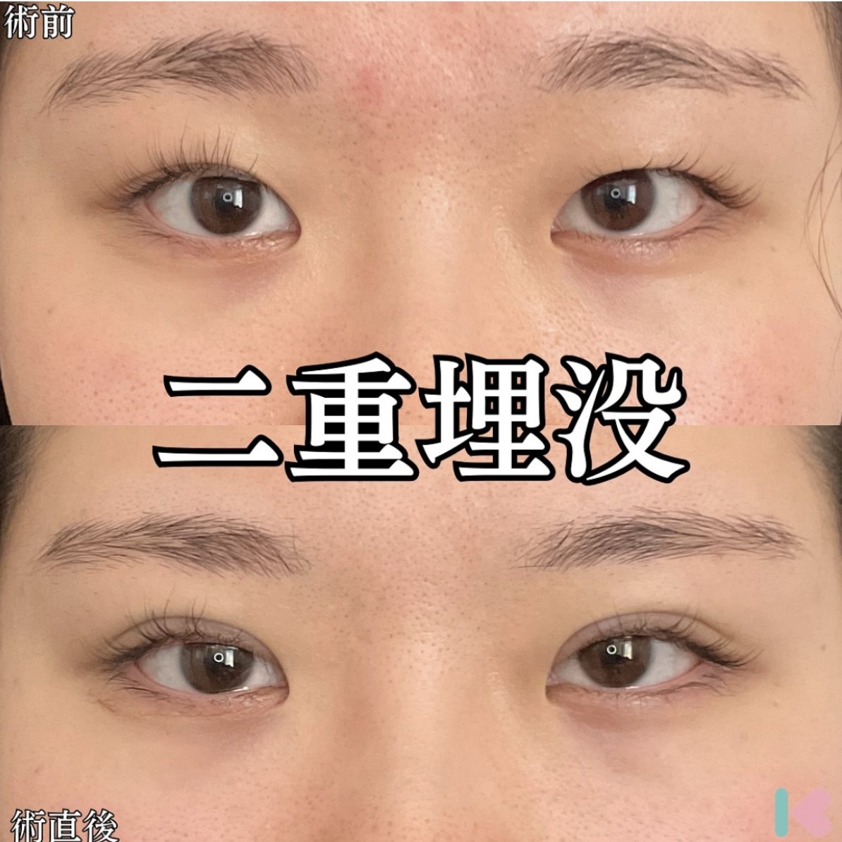 二重埋没