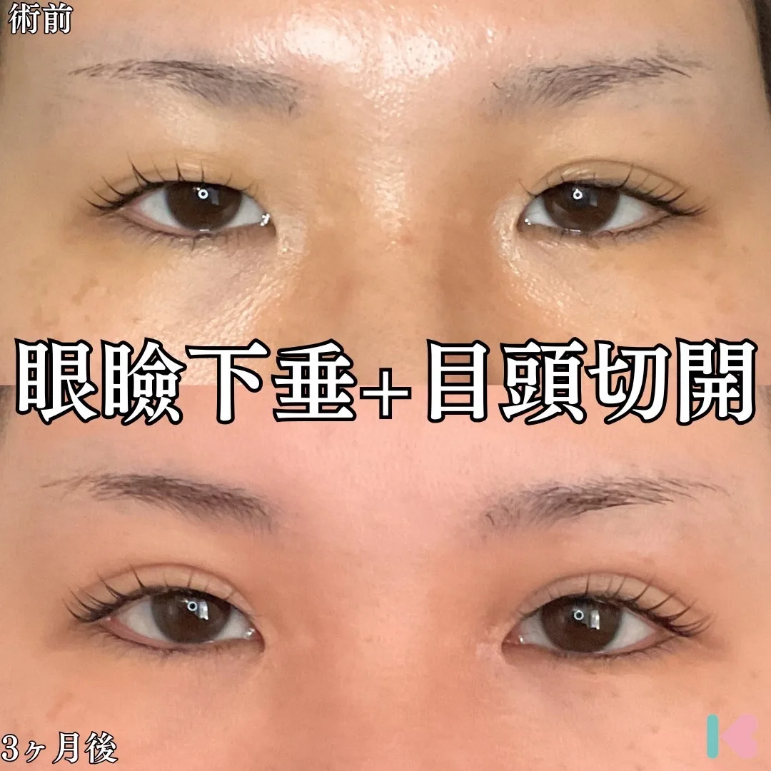 眼瞼下垂