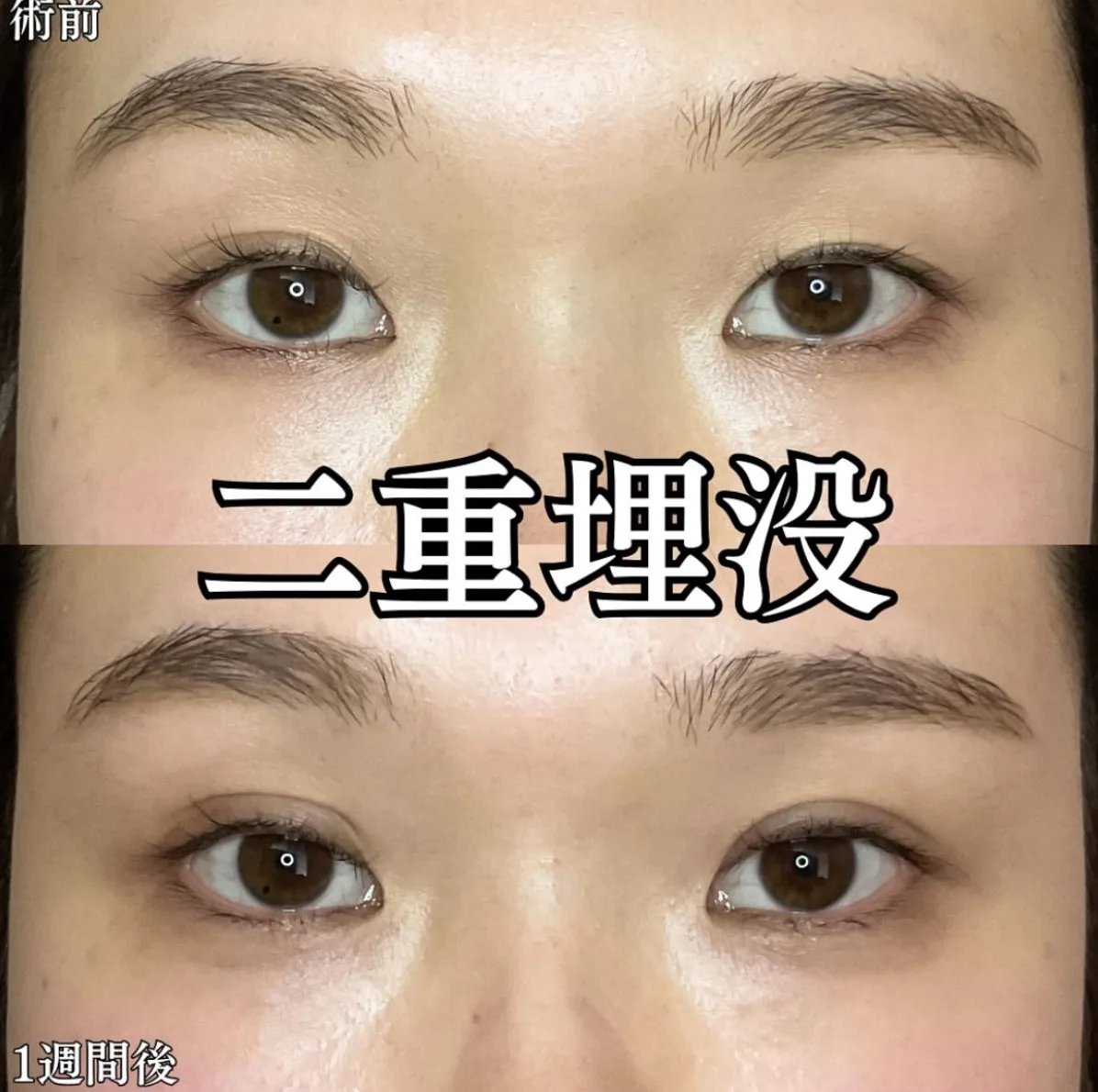 二重埋没