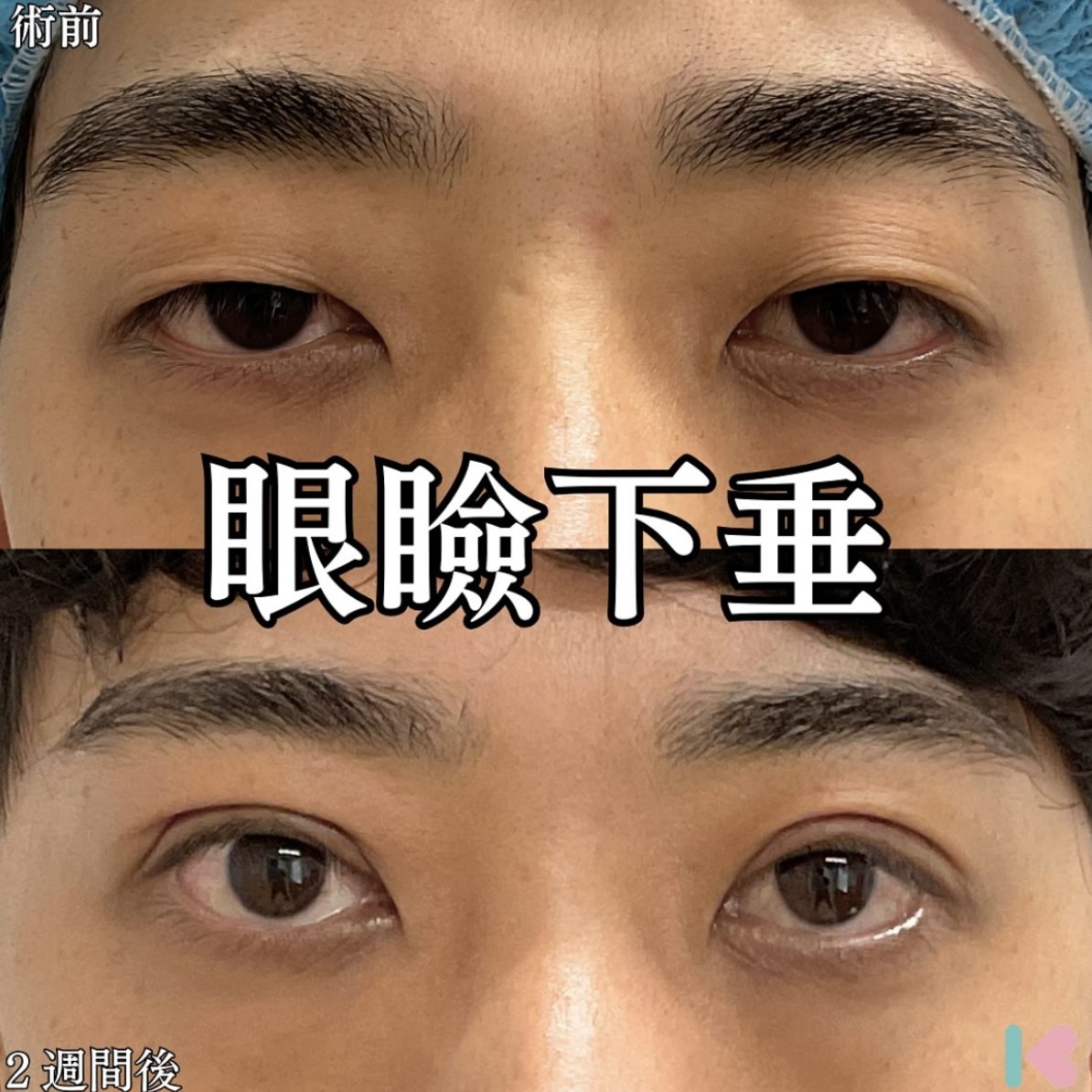 眼瞼下垂