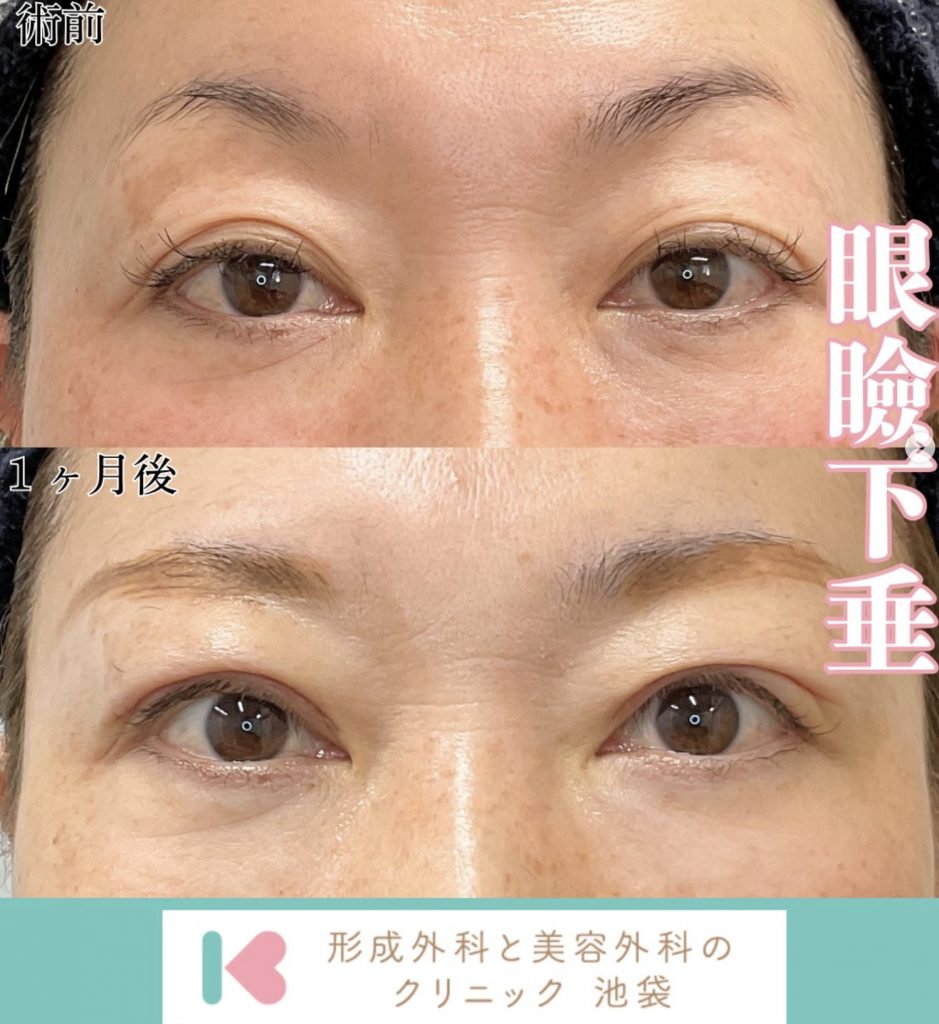 眼瞼下垂1ヶ月後
