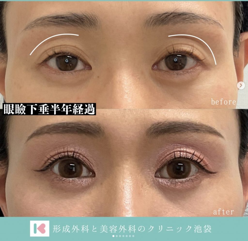 眼瞼下垂手術後半年事例