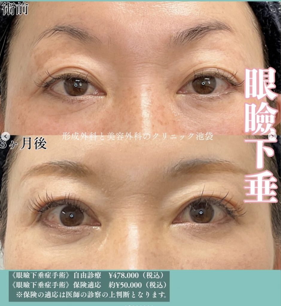 眼瞼下垂手術3ヶ月後