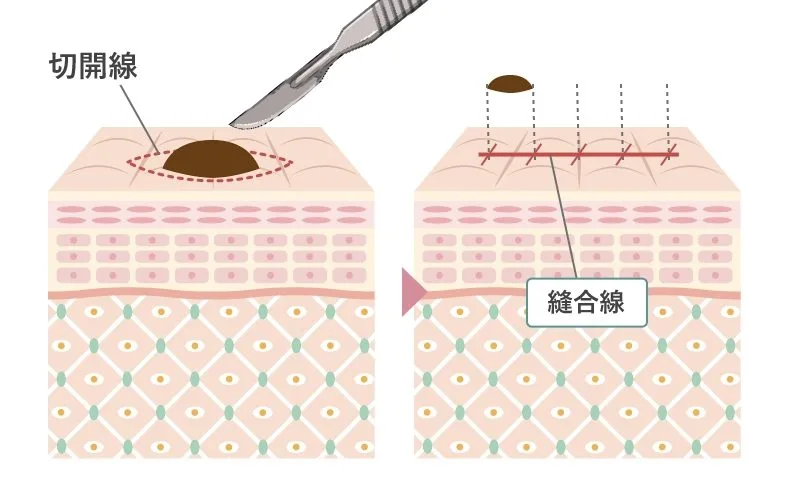 切開法