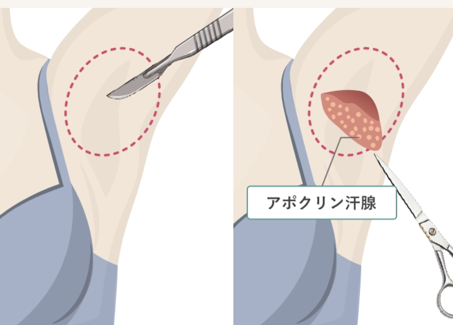 ワキガ手術