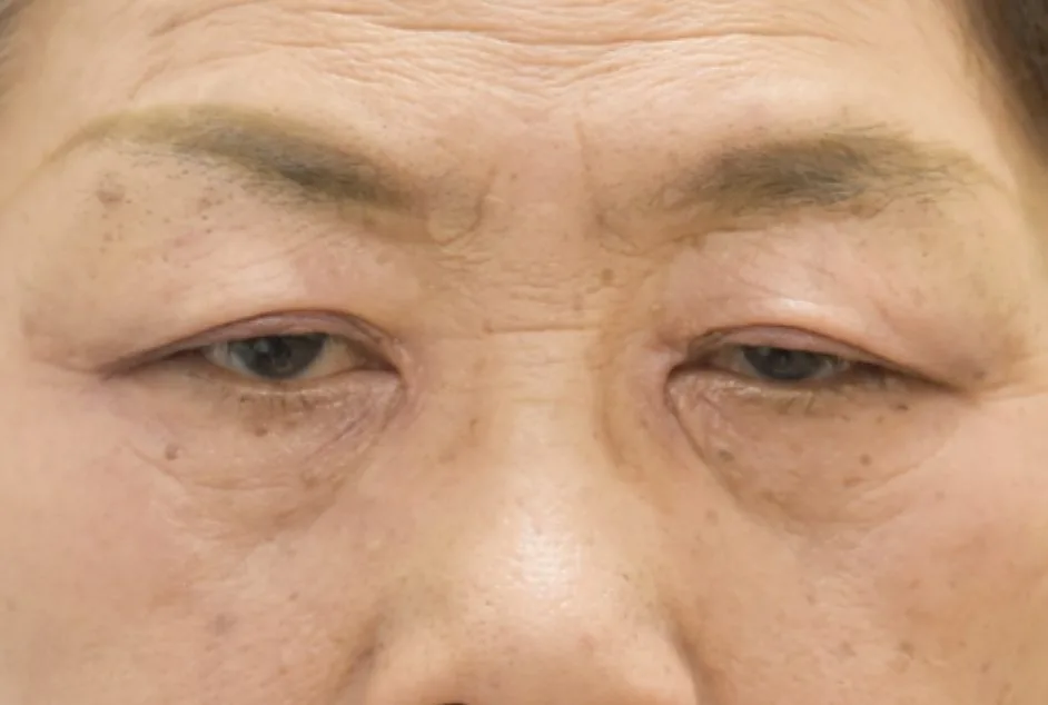 眼瞼下垂術前