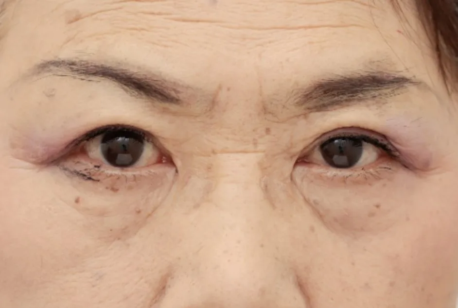 眼瞼下垂術後