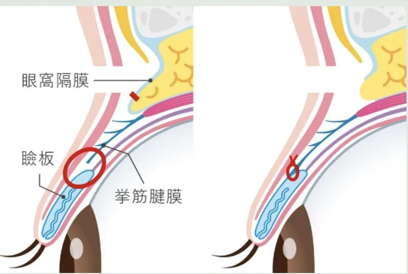 眼瞼下垂治療