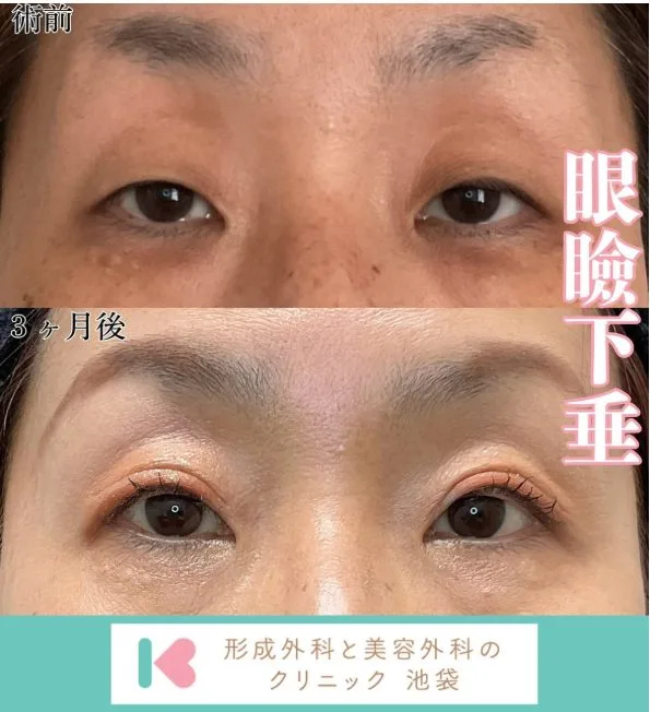 眼瞼下垂の症例写真