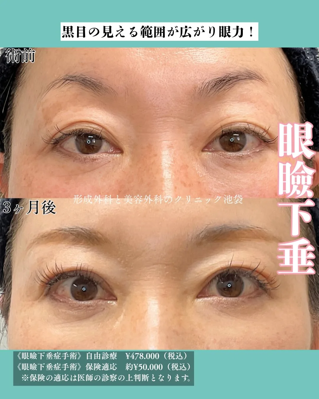 挙筋前転法による眼瞼下垂手術の術前・術後3ヶ月の比較写真