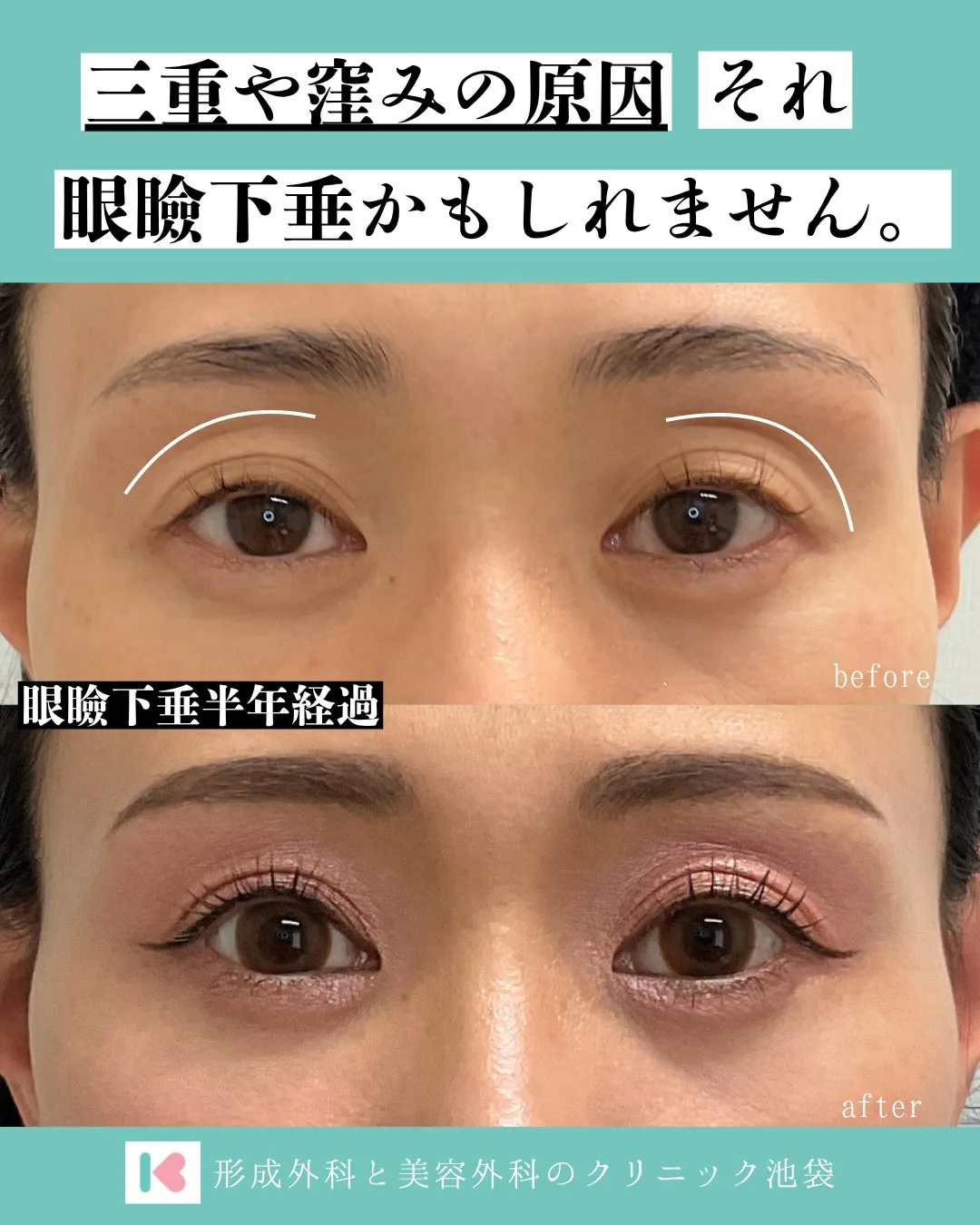 眼瞼挙筋前転法による眼瞼下垂手術の症例写真、術後半年の状態