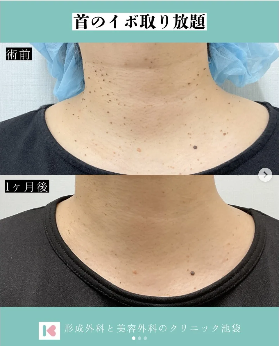 首のいぼ（隆起性病変）をくり抜き法で切除した症例写真、術前と1ヶ月後の比較