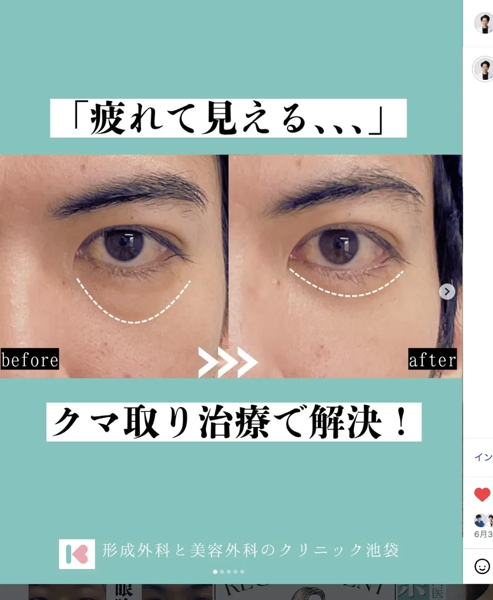 経結膜脱脂による目の下のクマ取り症例写真、術前と術後の比較