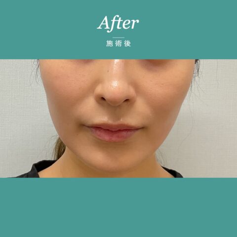 糸リフトの施術1ヶ月後（正面）｜ダウンタイム終了後の状態