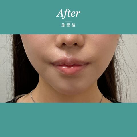 糸リフトの施術1ヶ月後（正面）｜控えめな本数でダウンタイムを抑えた症例