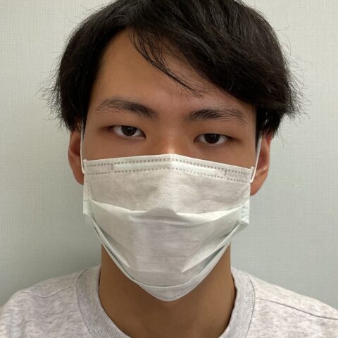 眼瞼下垂（上まぶたが黒目に軽くかかる事例） 施術前