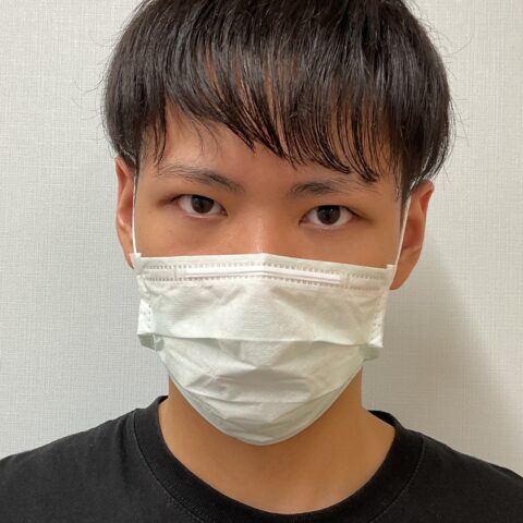 眼瞼下垂（上まぶたが黒目に軽くかかる事例） 施術後