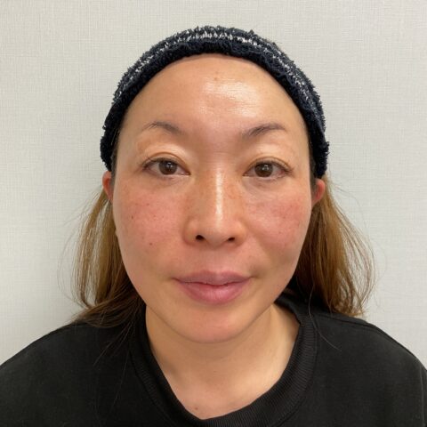 眼瞼下垂 施術前