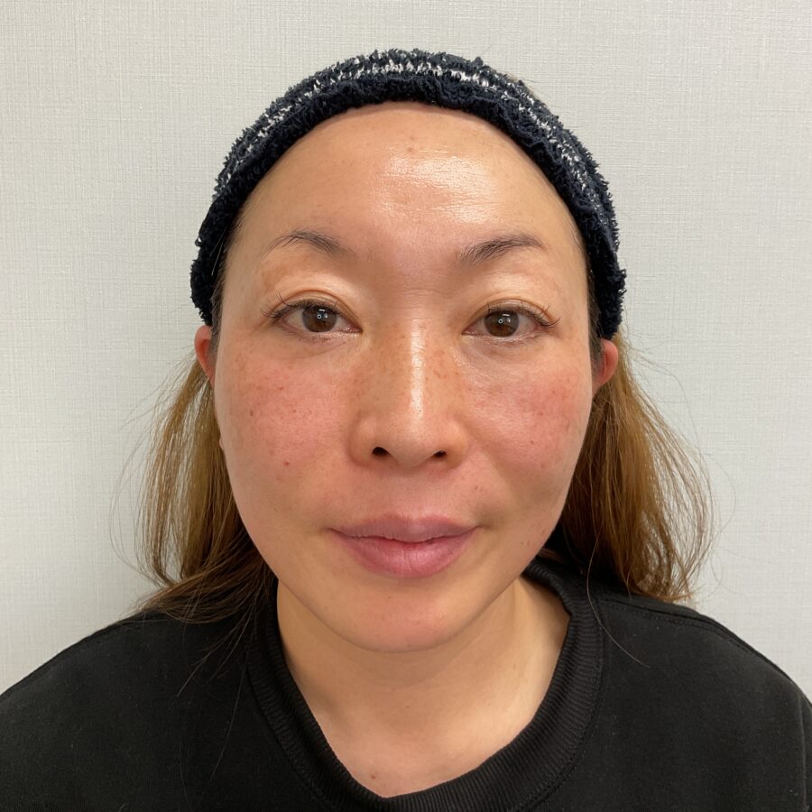 眼瞼下垂 施術前
