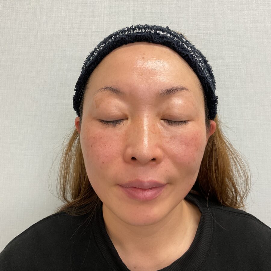 眼瞼下垂 施術前（2枚目）