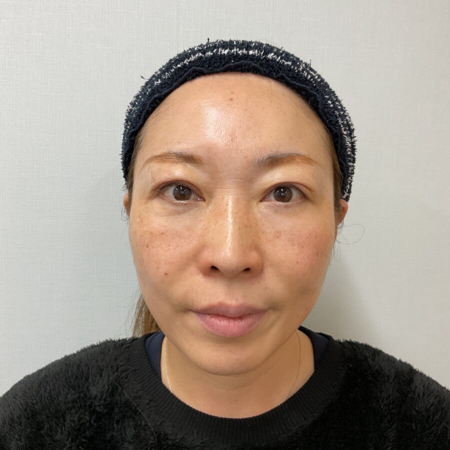 眼瞼下垂 施術後