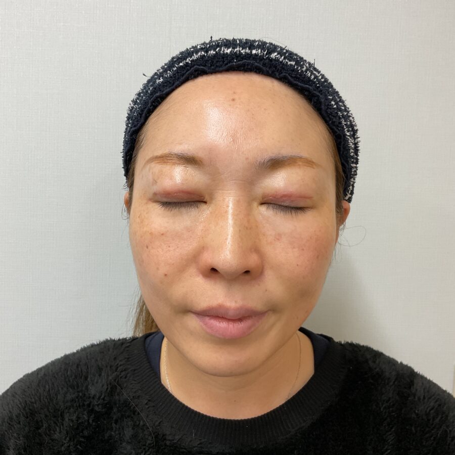 眼瞼下垂 施術後（2枚目）