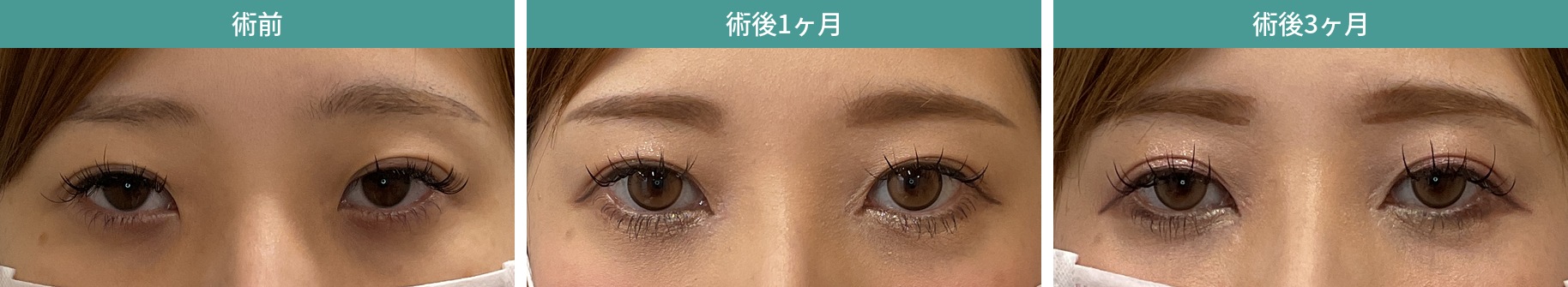 目頭切開・グラマラスライン形成の症例：術前／術後1ヶ月／術後3ヶ月