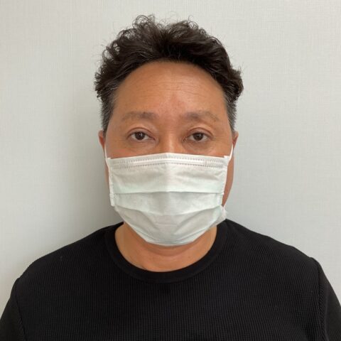 眼瞼下垂（目が開きにくく眠たそうに見える事例） 施術後