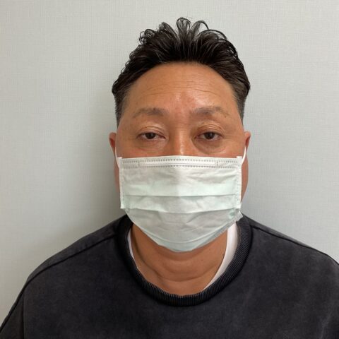 眼瞼下垂（目が開きにくく眠たそうに見える事例） 施術前