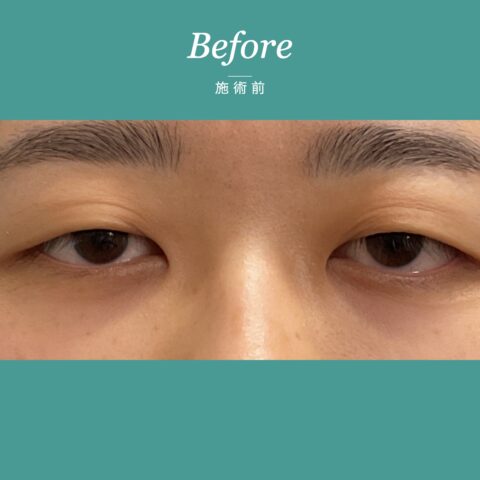 眼瞼下垂(保険適用:まぶたが黒目にかかる事例) 施術前