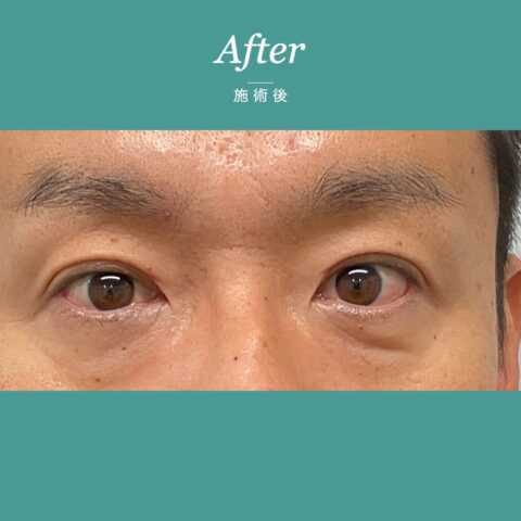 眼瞼下垂(保険適用:目の疲れにお悩みの事例) 施術後