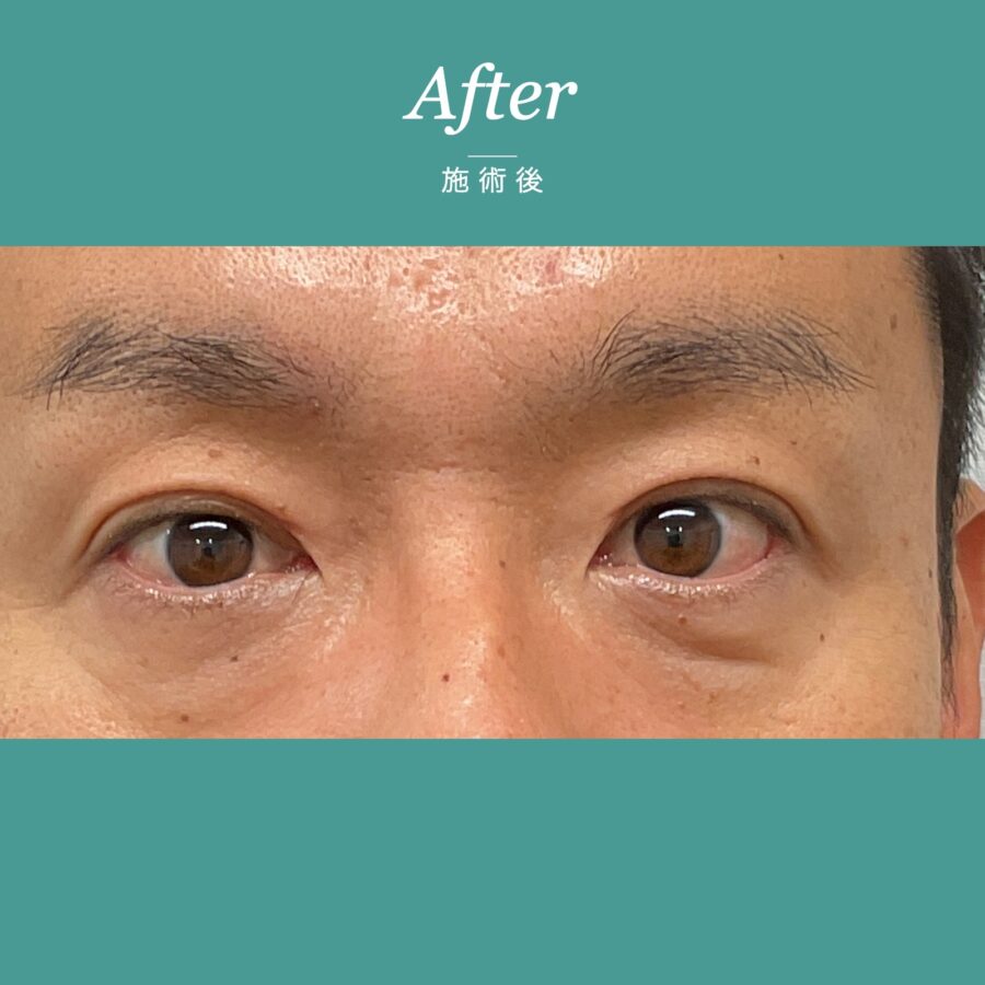 眼瞼下垂（保険適用：目の疲れにお悩みの事例） 施術後