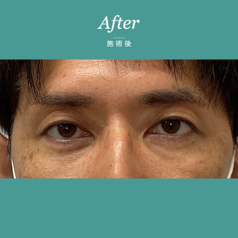 クマ取り（経結膜脱脂：ひふを切らない脂肪取り） 施術後